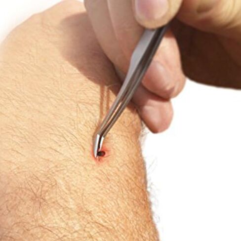 Tick Remover Tool Kit & Tick Identifier Card - Hygienic Stainless Steel in Saudi Arabia