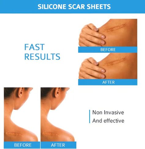 أوراق ندبات السيليكون القابلة لإعادة الاستخدام، شرائط السيليكون الطبية لقطع الحروق الجراحية على القسم C، علاج ندبات الجدرة الضخامية، 6 عبوات 5.9 بوصة × 1.6 بوصة (15 سم × 4 سم) in Kuwait