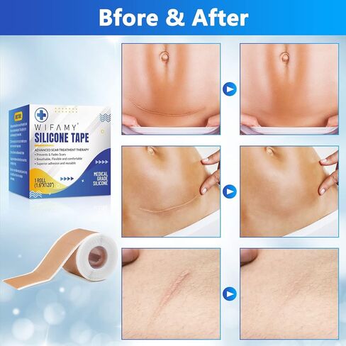 ويفامي اوراق ندبات من السيليكون، شريط سيليكون للندبات مقاس 1.6 انش × 120 انش، شرائط علاج فعالة وقابلة لاعادة الاستخدام لازالة الندوب التي تسببها القسم C وندوب الحروق والجراحة وحب الشباب، 3 متر in Kuwait