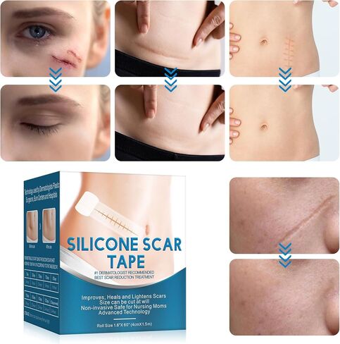 شريط ندبات من السيليكون، شرائط، صفائح (1.6 بوصة × 60 بوصة)، لفافة شريط ندبات من السيليكون - تنعيم وتسطح الندبات الناتجة عن الجراحة، الجدرة، الحروق، حب الشباب، العمليات القيصرية والمزيد، رقعة احترافية لعلاج الندبات in Kuwait