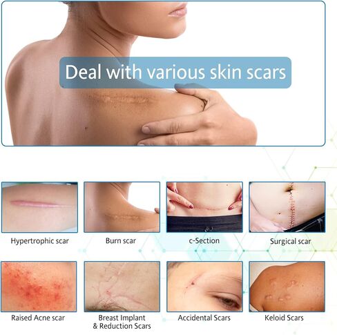شريط ندبات من السيليكون، شرائط، صفائح (1.6 بوصة × 60 بوصة)، لفافة شريط ندبات من السيليكون - تنعيم وتسطح الندبات الناتجة عن الجراحة، الجدرة، الحروق، حب الشباب، العمليات القيصرية والمزيد، رقعة احترافية لعلاج الندبات in Kuwait