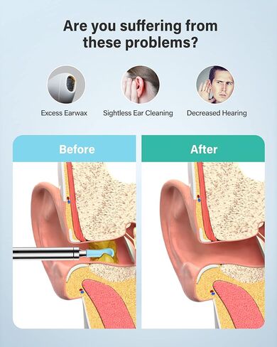Xlife Earwax Removal Tool with 6 Led Lights,1080p FHD Camera Ear Cleaner, Ear Camera with A Intelligent Gyroscope for iPhone ONLY (Blue) in Kuwait