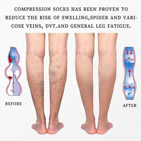LIN PERFORMANCE Compression Socks for Women and Men Knee High Open Toe Medical Compression Stockings Varicose Vein Swollen legs Travel in Saudi Arabia