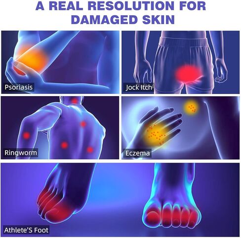 كريم حكة جوك من بيو إم دي، كريم حكة جوك بقوة إضافية للرجال والنساء، كريم الصدفية، علاج السعفة للبشر، كريم الحكة - راحة قوية وسريعة in Kuwait