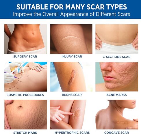 جل إزالة الندبات السيليكون من ريسريزون: كريم متطور لإصلاح الندبات لجسم الوجه - علاج طبي للندبات الجراحية وعلامات التمدد وحرق الجدرة وإصابات شد البطن وندبات حب الشباب 1.06 جم in Kuwait