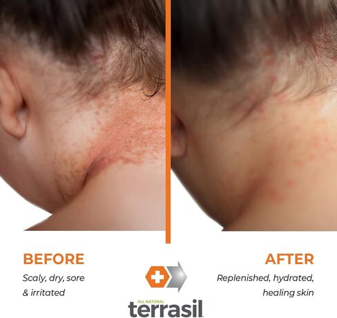 كريم إكزيما - تركيبة ثلاثية المفعول حاصلة على براءة اختراع طبيعية بالكامل لصدفية الإكزيما الشديدة والطفح الجلدي والطفح الجلدي الوردي لعلاج التهاب الجلد المتهيج والمتشقق والحكة من تيراسيل in Kuwait