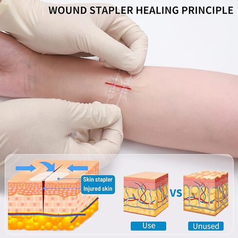 Emergency Wound Closure Zippers, 4 Pcs Zip Stitch Sutures Butterfly Bandaids, Repair Wounds Without Stitches, Great for Outdoor Activities, Quick Clot -Emergency Wound Closures Device in Kuwait