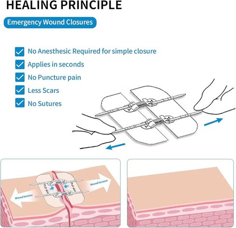 Emergency Wound Closure Zippers, 4 Pcs Zip Stitch Sutures Butterfly Bandaids, Repair Wounds Without Stitches, Great for Outdoor Activities, Quick Clot -Emergency Wound Closures Device in Kuwait