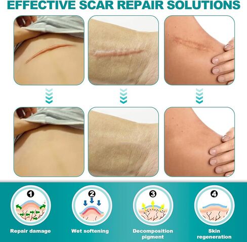 أوراق ندبات طويلة للغاية من السيليكون (لفة 1.6 بوصة × 200 بوصة - 5 أمتار)، شريط ندبات من السيليكون، أوراق إزالة الندبات قابلة لإعادة الاستخدام، شرائط احترافية لإزالة الندبات للندبات الجراحية، الجدرة، القسم القيصري، الحروق، حب الشباب، إلخ in Kuwait