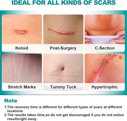 أوراق ندبات طويلة للغاية من السيليكون (لفة 1.6 بوصة × 200 بوصة - 5 أمتار)، شريط ندبات من السيليكون، أوراق إزالة الندبات قابلة لإعادة الاستخدام، شرائط احترافية لإزالة الندبات للندبات الجراحية، الجدرة، القسم القيصري، الحروق، حب الشباب، إلخ in Kuwait