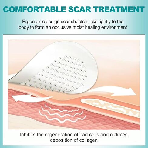 أوراق ندبات طويلة للغاية من السيليكون (لفة 1.6 بوصة × 200 بوصة - 5 أمتار)، شريط ندبات من السيليكون، أوراق إزالة الندبات قابلة لإعادة الاستخدام، شرائط احترافية لإزالة الندبات للندبات الجراحية، الجدرة، القسم القيصري، الحروق، حب الشباب، إلخ in Kuwait