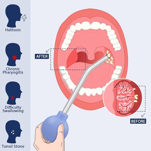 مجموعة إزالة أحجار اللوزتين، 10 عبوات من أداة الحجامة الكهربائية لإزالة أحجار اللوزتين مع مرآة مكبرة 5 مرات، مصباح فموي، لإزالة أحجار اللوزتين in Kuwait