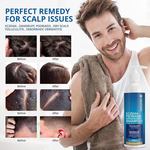 شامبو الأكزيما شامبو الصدفية: شامبو التهاب الجلد الدهني - علاج الصدفية في فروة الرأس - شامبو التهاب الجريبات in Kuwait