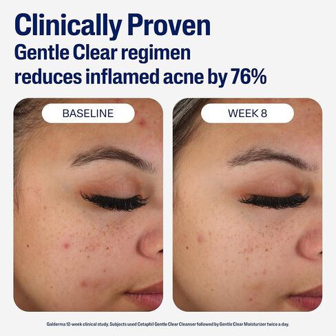 Cetaphil Face Moisturizer, Gentle Clear Mattifying Acne Moisturizer With 0.5% Salicylic Acid, Hydrates and Treats Sensitive Acne Prone Skin, Skin Care for Sensitive Skin, 3oz in Kuwait