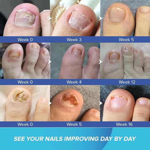Toenail Fungus Treatment Extra Strength - Nail Fungus Treatment for Toenail - Toe Nail Fungus Treatment - Toenail Fungus Treatment - Nail Repair Solution for Fungal Fingernails & Toenails, 1 Fl Oz in Saudi Arabia