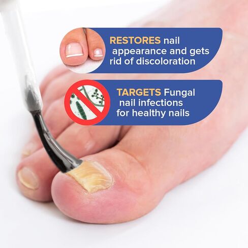 Toenail Fungus Treatment Extra Strength - Nail Fungus Treatment for Toenail - Toe Nail Fungus Treatment - Toenail Fungus Treatment - Nail Repair Solution for Fungal Fingernails & Toenails, 1 Fl Oz in Saudi Arabia