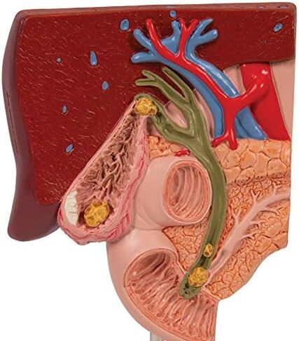 3B Scientific K26 Gallstone Model - 3B Smart Anatomy in Saudi Arabia