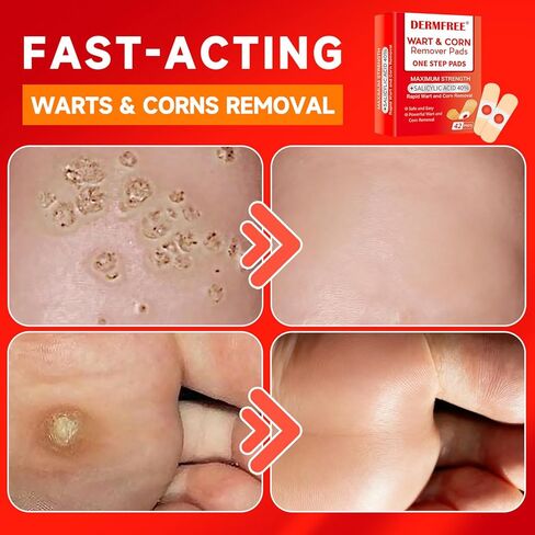 وسادات لإزالة الثآليل لأصابع القدم والقدمين، 40% حمض الساليسيليك، محلول آمن وفعال للعناية بالقدم (42 وسادة) in Kuwait