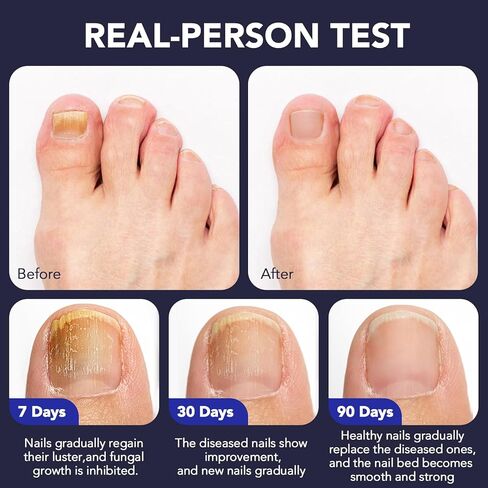 Toenail Fungus Pen - 25% Undecylenic Acid, Tea Tree Oil - Toenail Fungus Treatment Extra Strength for Toe Nail Repair Pen for Damaged Nails, Foot Fungal Nail Treatment for Fungi Funginail - 5pcs in Saudi Arabia