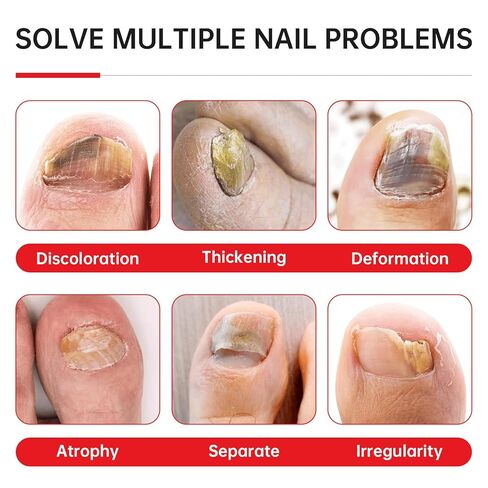 علاج فطريات الأظافر بقوة إضافية - 25% حمض غير ديسيلينيك، تركيبة نباتية لطيفة لأظافر الأصابع، يعالج تحت الأظافر وحولها، يعالج تغير اللون، ويصلح الأظافر السميكة والتالفة، 1.01 أونصة سائلة in Kuwait