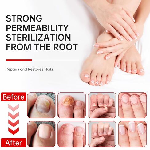 علاج فطريات الأظافر بقوة إضافية - 25% حمض غير ديسيلينيك، تركيبة نباتية لطيفة لأظافر الأصابع، يعالج تحت الأظافر وحولها، يعالج تغير اللون، ويصلح الأظافر السميكة والتالفة، 1.01 أونصة سائلة in Kuwait
