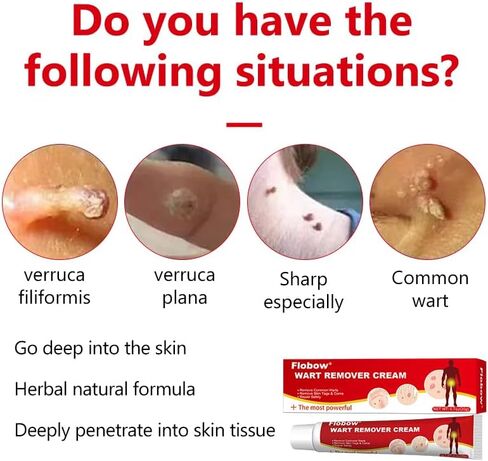 مزيل الثآليل 20 جرام، علاج فعال للثؤلول، الشامات ومسامير القدم، مناسب للوجه والجسم، مزيل علامات الجلد، لمنع انتشار الثآليل in Kuwait