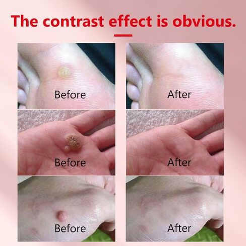 مزيل الثآليل 20 جرام، علاج فعال للثؤلول، الشامات ومسامير القدم، مناسب للوجه والجسم، مزيل علامات الجلد، لمنع انتشار الثآليل in Kuwait