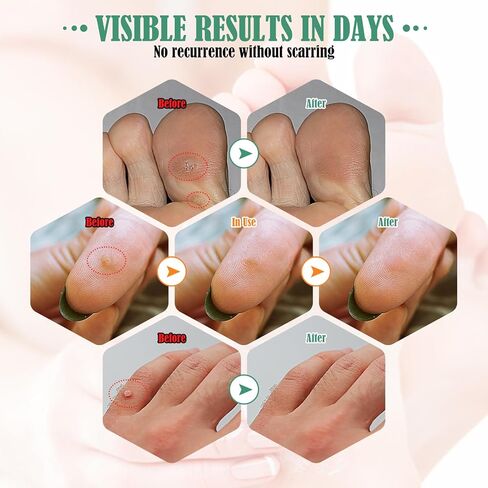 ضمادات طبية سريعة الفعالية للبالغين، وسادات مزيلة للذرة مع 40% حمض الساليسيليك - 36 قطعة، علاج سريع وفعال للقدمين وأصابع القدم in Kuwait