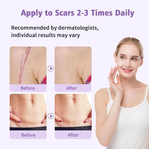 Silicone Scar Gel Scar Cream, Treats Old and New Scars, Stretch Marks Removal Formula Helps from Surgical, Burns, Acne Scar Treatment with Advanced Scar Gel, 1.7 oz (50ml) in Saudi Arabia