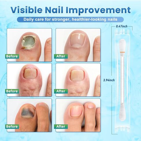 Fungal Nail Treatment Swabs–100 Ct, Extra Strength Toenail & Athlete’s Foot Fungus Treatment with 25% Undecylenic Acid, Damaged, Discolored & Thick Nails, Restores Healthy Nail Growth in Saudi Arabia