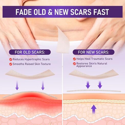 شريط الندبات للندبات الجراحية - أوراق الندبات المصنوعة من السيليكون الطبي وشريط الندبات لإزالة الجدرة، واستعادة القسم C، وشد البطن، وعلامات الحروق أو الإصابة، وشرائط السيليكون الناعمة القابلة لإعادة الاستخدام (1.6 بوصة × 60 بوصة) in Kuwait