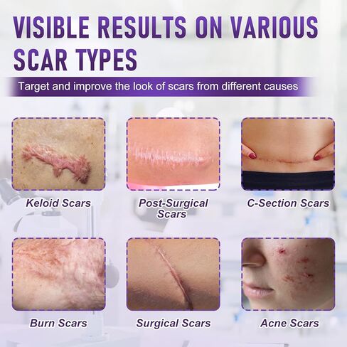 شريط الندبات للندبات الجراحية - أوراق الندبات المصنوعة من السيليكون الطبي وشريط الندبات لإزالة الجدرة، واستعادة القسم C، وشد البطن، وعلامات الحروق أو الإصابة، وشرائط السيليكون الناعمة القابلة لإعادة الاستخدام (1.6 بوصة × 60 بوصة) in Kuwait