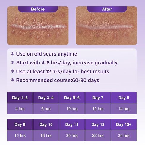 شريط الندبات للندبات الجراحية - أوراق الندبات المصنوعة من السيليكون الطبي وشريط الندبات لإزالة الجدرة، واستعادة القسم C، وشد البطن، وعلامات الحروق أو الإصابة، وشرائط السيليكون الناعمة القابلة لإعادة الاستخدام (1.6 بوصة × 60 بوصة) in Kuwait