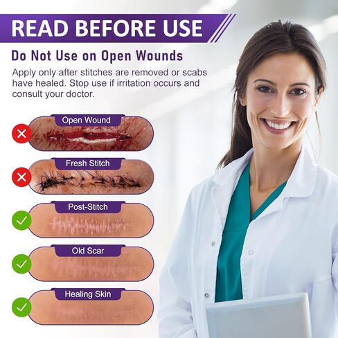 شريط الندبات للندبات الجراحية - أوراق الندبات المصنوعة من السيليكون الطبي وشريط الندبات لإزالة الجدرة، واستعادة القسم C، وشد البطن، وعلامات الحروق أو الإصابة، وشرائط السيليكون الناعمة القابلة لإعادة الاستخدام (1.6 بوصة × 60 بوصة) in Kuwait