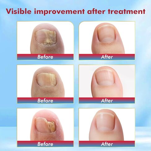 Fungal Nail Treatment Swabs-50ct, Extra Strength 25% Undecylenic Acid for Toenail Fungus, Athlete’s Foot, Damaged, Discolored & Thick Nails, Restores Healthy Nail Growth in Saudi Arabia