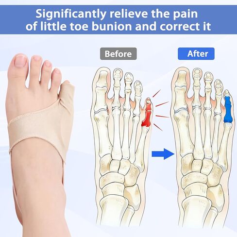 Cuffbow 2 Pair Tailor Bunion Corrector Pads for Pinky Toe Relief Little Toe Separator Bunionette Sleeves Relieve Bunion Pain with Soft Latex Pads and Non-Slip Strap for Women Men Overlapping Toes, L in Saudi Arabia