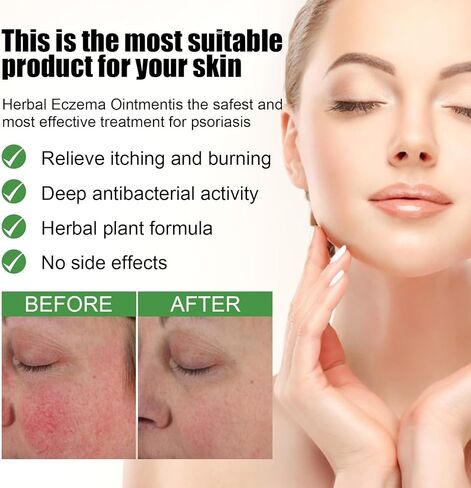 كريم مضاد للفطريات: كريم حكة جوك، كريم مهدئ لتخفيف الأكزيما، عناية طبيعية مهدئة بالكامل وتخفيف سريع لحكة جوك والأكزيما والصدفية - علاج السعفة للبشر - للبالغين والأطفال in Kuwait