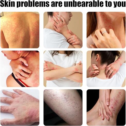 كريم مضاد للفطريات: كريم حكة جوك، كريم مهدئ لتخفيف الأكزيما، عناية طبيعية مهدئة بالكامل وتخفيف سريع لحكة جوك والأكزيما والصدفية - علاج السعفة للبشر - للبالغين والأطفال in Kuwait