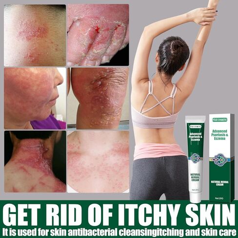 كريم مضاد للفطريات: كريم حكة جوك، كريم مهدئ لتخفيف الأكزيما، عناية طبيعية مهدئة بالكامل وتخفيف سريع لحكة جوك والأكزيما والصدفية - علاج السعفة للبشر - للبالغين والأطفال in Kuwait