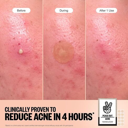 PEACE OUT Acne Healing Dots Helps Clear Blemishes Overnight, Fast Acting Hydrocolloid Pimple Patches for Breakouts with Salicylic Acid, Retinol and Aloe Vera, Award Winning Skincare Solution 40 Count in Saudi Arabia