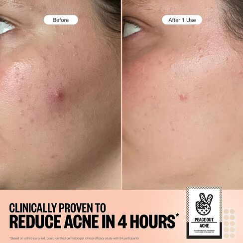 PEACE OUT Acne Healing Dots Helps Clear Blemishes Overnight, Fast Acting Hydrocolloid Pimple Patches for Breakouts with Salicylic Acid, Retinol and Aloe Vera, Award Winning Skincare Solution 40 Count in Saudi Arabia