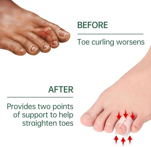 Gel Hammer Toe Corrector - Hammer Toe Straightener for Women and Men, Toe Protectors & Hammer Toe Cushion, Soft Silicone Hammer Toe Straightener Corrector, Pack of 8 in Saudi Arabia