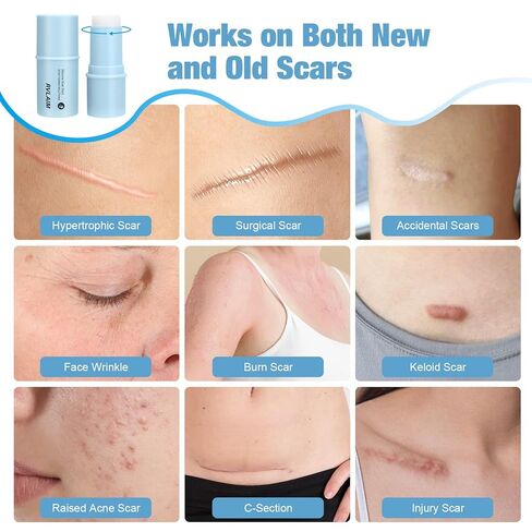 Silicone Scar Stick, 80% Silicone Stick for Face and Body. Silicone Stick for Removal of Surgical,Old and Recent Scars and Stretch Marks - 7g in Kuwait