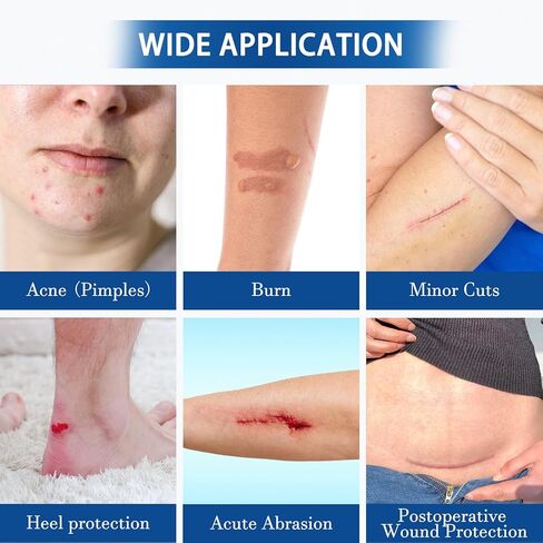 Hydrocolloid Bandages Roll，Medical Grade Hydrocolloid (2in*59in), Highly Absorbent Hydrocolloid Bandages for Wound Care, Burn, Blister, Acne Care, Waterproof & Cut to Required Size in Saudi Arabia