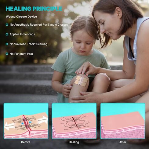 Emergency Wound Closure Strips 10 Pcs Zip Stitch Butterfly Bandages Laceration Closure Suture Kit, Adhesive Zip Tie Stitchless Painless Steri Strips for Wound Care in Saudi Arabia