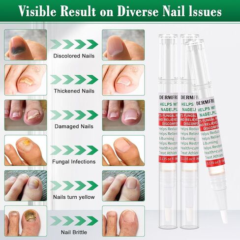 Toe Nail Fungus Renewal Pen, Toenail Fungus Renewal, 3 Packs Powerful Fast Acting For Thick, Discolored, Broken & Damaged Toe & Finger Nail in Saudi Arabia