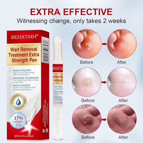 BEHATMH 3 Pack Wart Remover with Precision Tip, Maximum-Strength Salicylic Acid for Common & Plantar Warts, Targeted Mess-Free Application for Hands & Feet, Easy Daily Use in Saudi Arabia