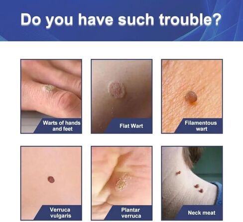 Allisthere Wart & Corn Remover, Easy to Use-Fast Removal of Flat Warts, Common Warts and Corns - Safe, Natural, and Potent for External Use in Saudi Arabia