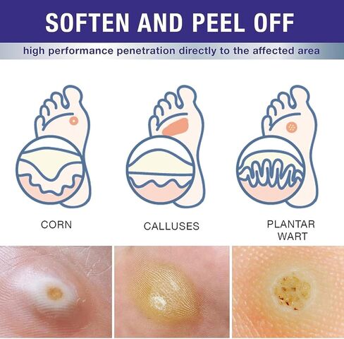 Allisthere Wart & Corn Remover, Easy to Use-Fast Removal of Flat Warts, Common Warts and Corns - Safe, Natural, and Potent for External Use in Saudi Arabia