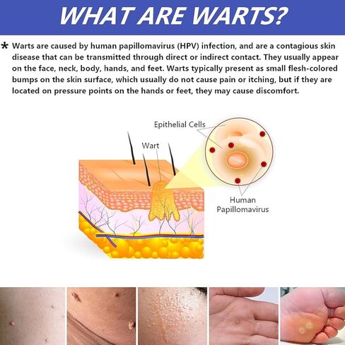 Allisthere Wart & Corn Remover, Easy to Use-Fast Removal of Flat Warts, Common Warts and Corns - Safe, Natural, and Potent for External Use in Saudi Arabia